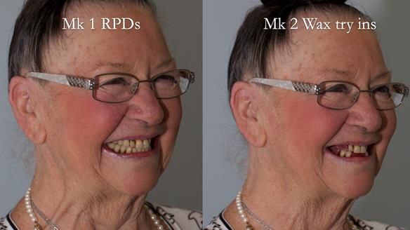 Finlay's Case Study Newsletter 40 - Immediate Mk 1 RPD to Definitive Mk 2 RPD - full protocol