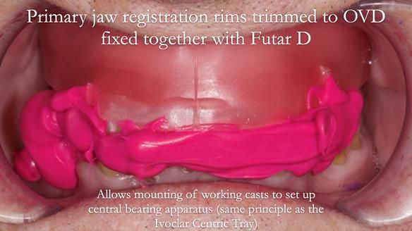 Newsletter 54 case presentation upper complete denture and lower Scandinavian designed hygienic partial denture for David