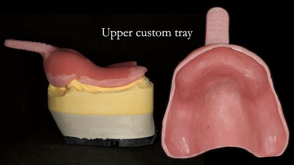 Newsletter 76: Jackie’s case – Telescopic overdenture & precision RPD (the tricky truth!)