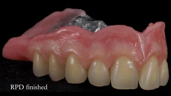 Newsletter 55 Provision of metal based partial dentures for Zephyrine with a repaired cleft lip and palate