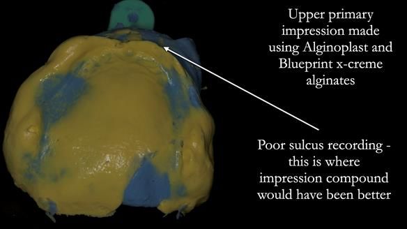 Newsletter 83: Sheila’s Complete Denture Success