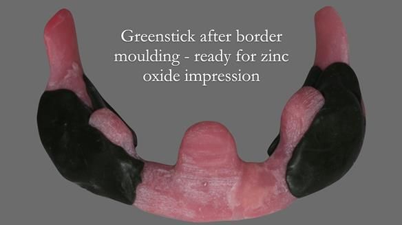 Finlay's Newsletter 62 provision of extractions and metal based complete dentures for Rafique