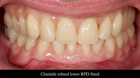 Newsletter 82 Mary - A complete upper and a one-tooth gasket denture
