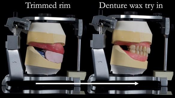 Newsletter 53 showing the making and fitting of ultra life-like dentures for Valena