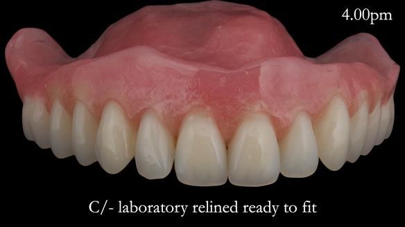 Newsletter 52 Managing Jo’s failing dentition with extractions and Mk 1/Mk 2 complete upper dentures and lower partial dentures FULL PROTOCOL