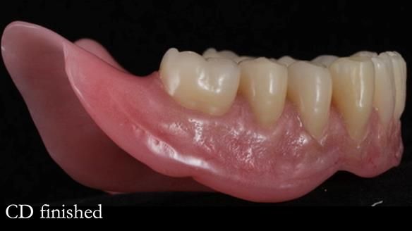 Finlay's Newsletter 62 provision of extractions and metal based complete dentures for Rafique