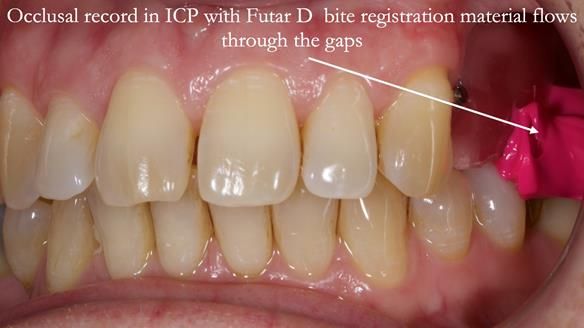Solving Sue's failed implants with metal based RPD - full protocol Newsletter 43