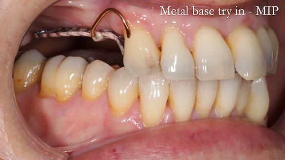 Newsletter 56 showing the making and fitting of a bilateral free end saddle upper removable partial denture (RPD) for patient with pemphigus