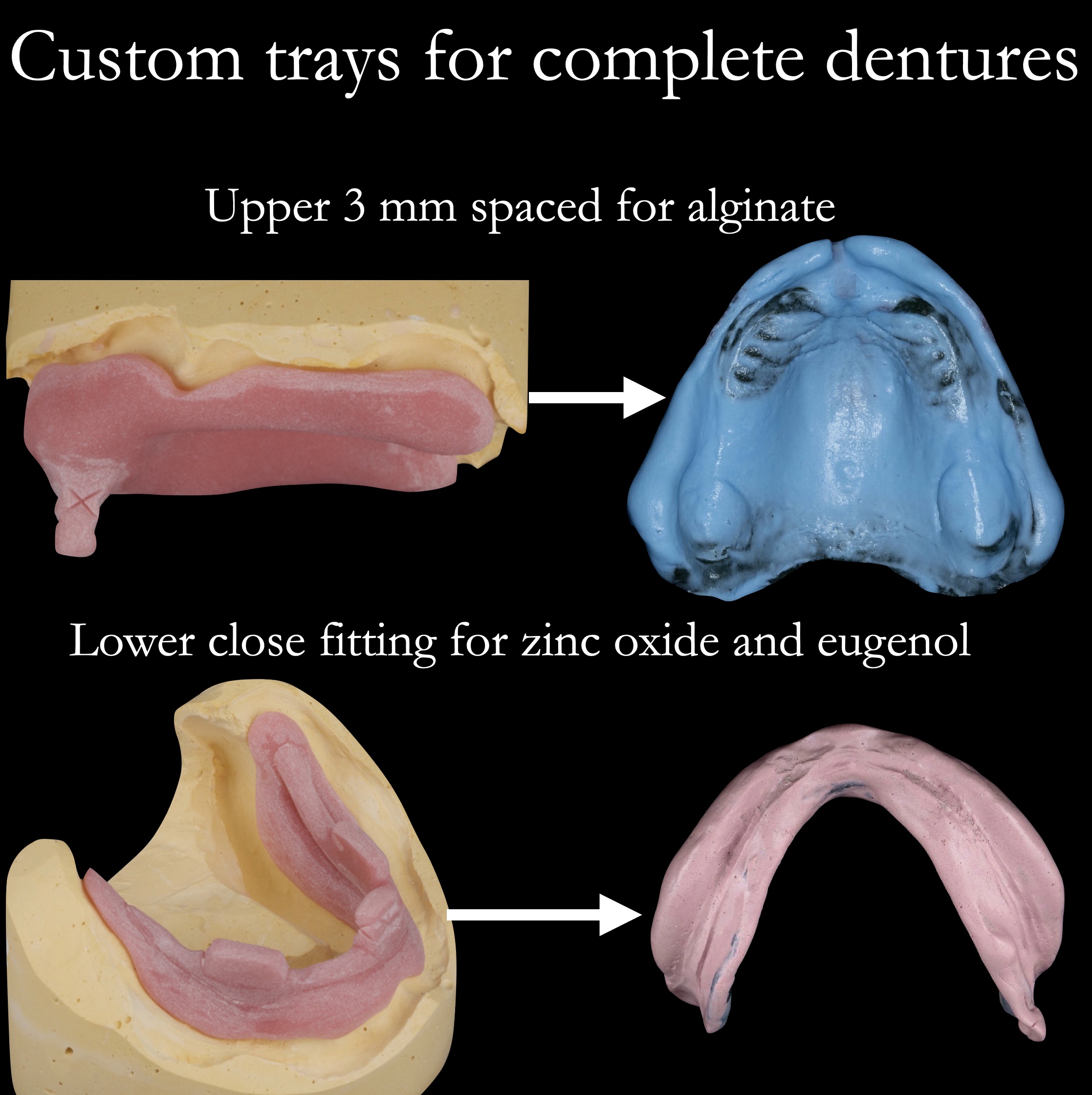 Spacing of custom trays for complete dentures