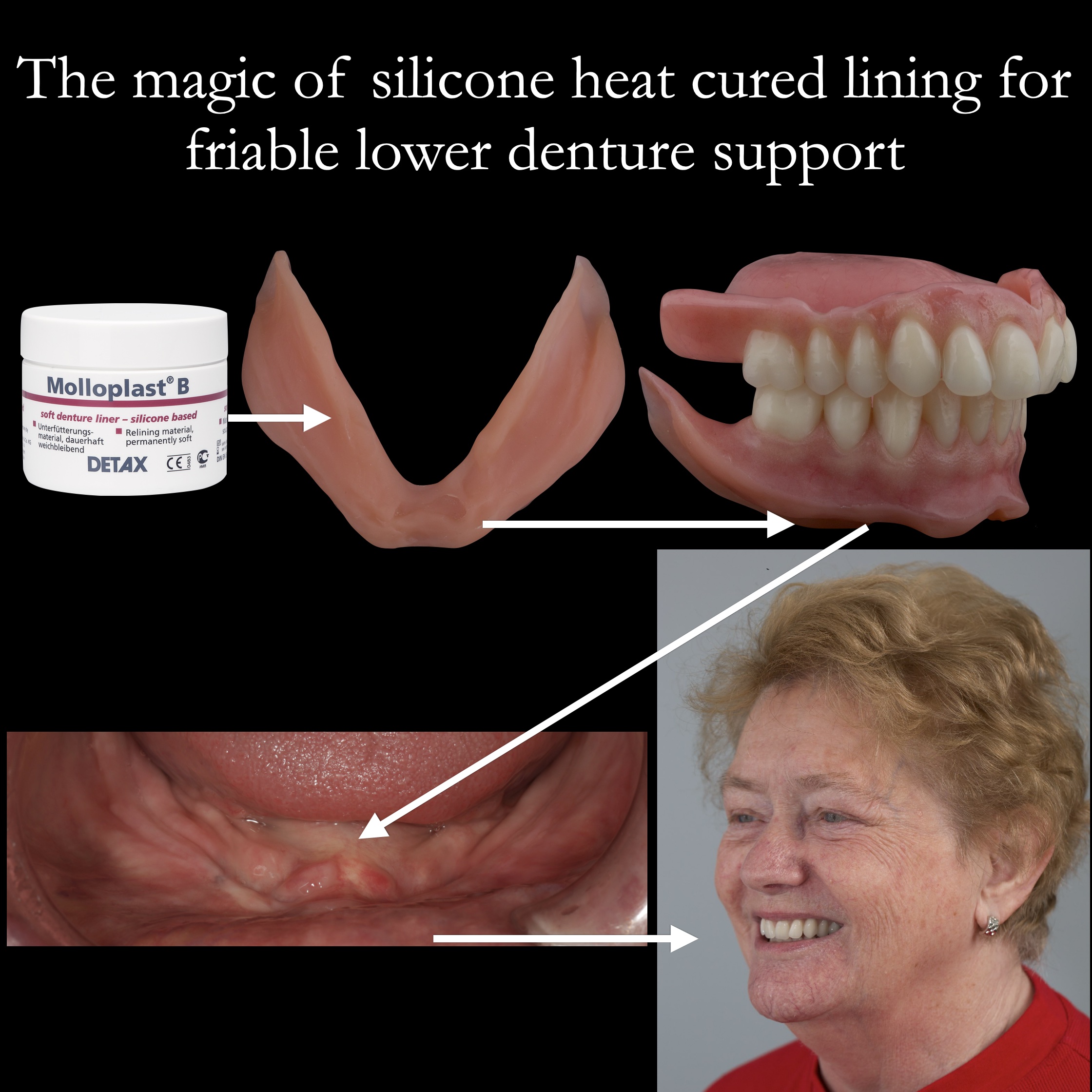 Liner for Dentures  